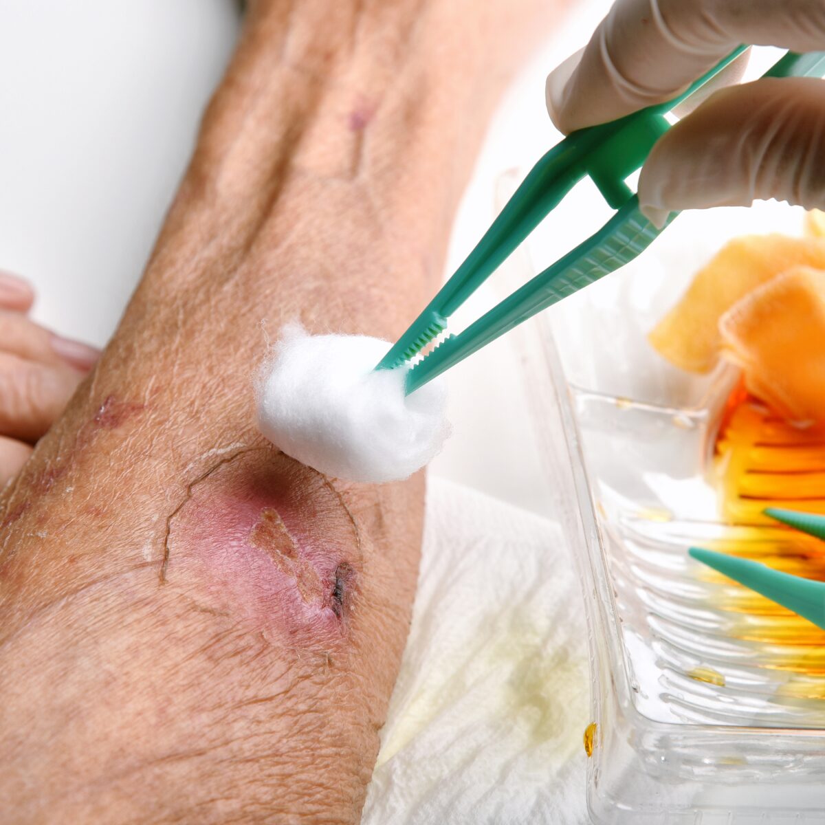 Close-up of a healing wound on an arm being treated with cotton and tweezers, surrounded by medical supplies. Represents advanced wound care techniques by Bio Cell Life, emphasizing non-invasive solutions for faster recovery.